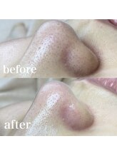 サロン ド ソワン(salon de soin)/毛穴エクストラクション