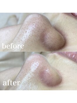 サロン ド ソワン(salon de soin)/毛穴エクストラクション