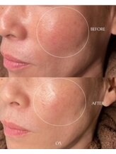 サンク(cinq)/LHA &nbsp;LALA　PEEL☆彡