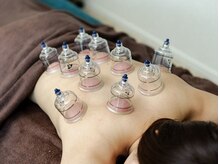 用賀駅前整骨院 鍼灸マッサージ院/カッピング