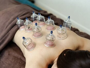 用賀駅前整骨院 鍼灸マッサージ院/カッピング