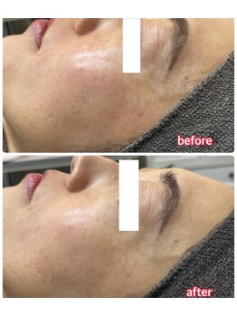 サロンドティアラ(Salon de Tiara)/シミケア(フォト)