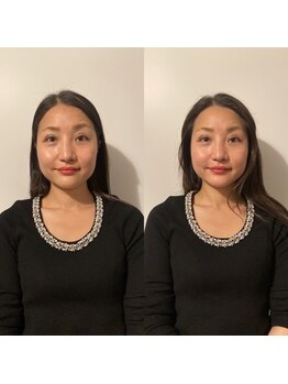 ルディア 堀江店(ledia)/お客様美容鍼のビフォーアフター