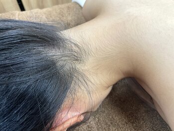 ハクミー(haku me)/うなじ脱毛 before