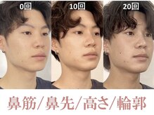 ラプリシュシュ 岡山店(Raplit)/ 隆鼻＋輪郭矯正40分30回