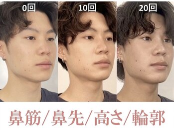 ラプリシュシュ 岡山店(Raplit)/ 隆鼻+輪郭矯正40分30回