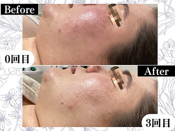 ポーベルポー(Peau Belle poe)/無添加幹細胞ハーブピーリング