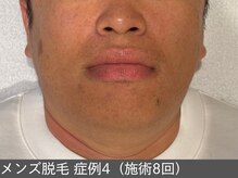 オアシスラグーン(OASIS LAGOON)/メンズ脱毛（症例4 施術8回）