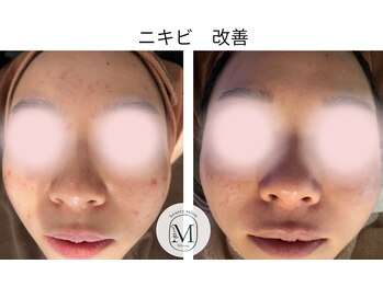 ミヨン(Miyong)/ニキビ改善