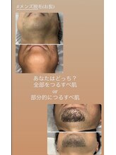 ラヴィエール(Laviere)/【メンズ脱毛髭】あなたはどっち