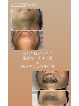 ラヴィエール(Laviere)/【メンズ脱毛髭】あなたはどっち