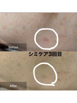 んまち/シミケア