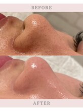 ファシネアオヤマ(FACINE AOYAMA)/施術1回でこの変化！