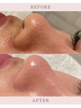 ファシネアオヤマ(FACINE AOYAMA)/施術1回でこの変化!