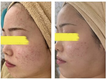 マーレン(Malen)/クリスティーナ症例写真