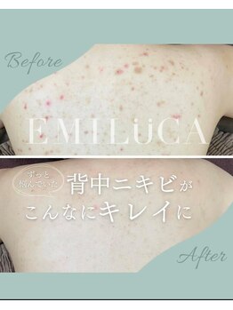 エミルカ 岡山店(EMILUCA)/お背中の施術事例8回目の来店時