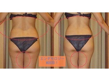 アイリスエステサロン 那覇小禄店/エンダモロジー