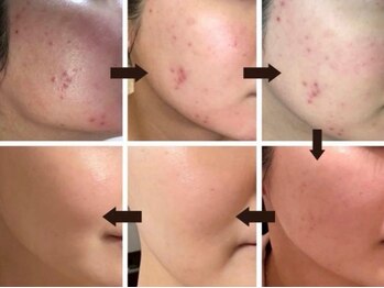 美肌ケアサロン iru 北千住店【ハーブピーリング | ララピール | 毛穴洗浄】/ハーブピーリングbefore/after