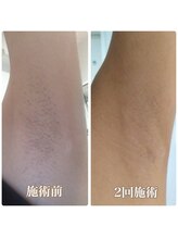 フェリス(FELIZ)/2回目施術後4週間経過