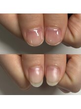 マニュコクーン(ManuCocoon)/爪育成　深爪　巻き爪　大阪市