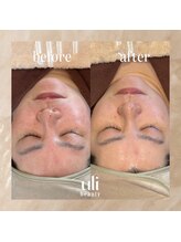 ウリ(uli beauty)/比較写真