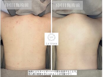 ラヴィオーラ 川崎(La Viora)/ダイヤモンドハーブピーリング