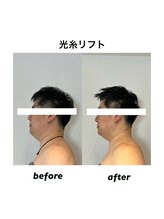アトリエドゥアージュ(Atelier de age)/フェイスラインスッキリ