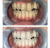 スマイルホワイト