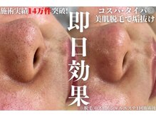 アルゴ 金沢増泉店(ALGO)/脱毛＋エステで肌質改善！
