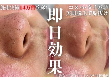 アルゴ 金沢増泉店(ALGO)/脱毛+エステで肌質改善!