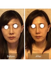 ユフラ/小顔コルギ