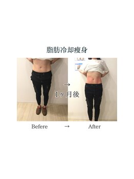 心斎橋長堀フェムテック整骨院/6　脂肪冷却　ぽっこりお腹
