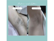 ワイエス(YS)/痛み少なく結果がでる脱毛