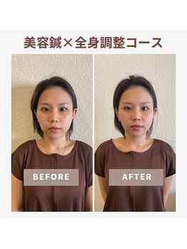 ベルソー鍼灸整体院(berceau鍼灸整体院)/美容はり×根本改善20代女性