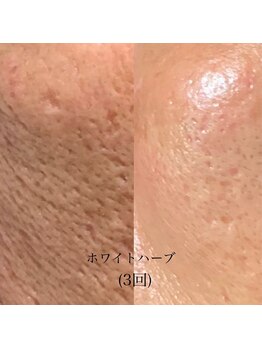 ラ ヴィレ ボーテ(La vraie beaute’)/before after