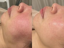 ビューティービレッジ(Beauty village)/超音波で小顔効果、リフトアップ