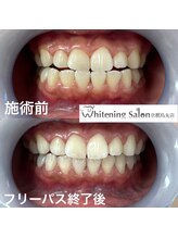 ホワイトニングサロン 京都烏丸店/ホワイトニング施術例