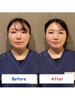 セイリキ(SEIRIKI)/3D小顔矯正