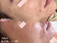 ヴェアリー 広尾(VARY)/繰り返す悩解消ハーブピーリング