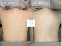 ラヴィオーラ 川崎(La Viora)/ダイヤモンドハーブピーリング