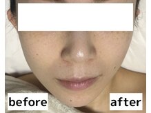 ライム 錦糸町(LIME)/Before/After