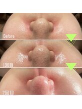 ステラ(STELLA)/ラミネーションピーリング