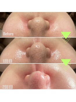 ステラ(STELLA)/ラミネーションピーリング