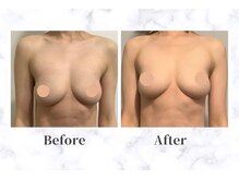 ふじこのきもちの雰囲気（授乳後の下垂した胸も、削げたデコルテも、諦めない！）