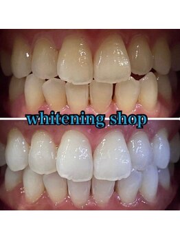 ホワイトニングショップ 長崎時津店/Before&After美白ホワイトニング