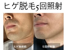 リリー(RILY)/【ビフォーアフター】