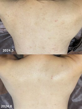 フルール(Fleur)/■背中トリートメント■