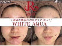 ホワイトアクア 新宿本店(WHITE AQUA)の雰囲気（毛穴・ニキビケアに！芸能人御用達『REVIハーブピーリング』）