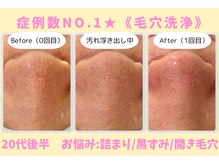 ウル 下北沢(Ulu)/韓国式３D毛穴洗浄