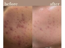 ユーアンドハニー(U&Honey.)/ハーブピーリング/ニキビ/赤み